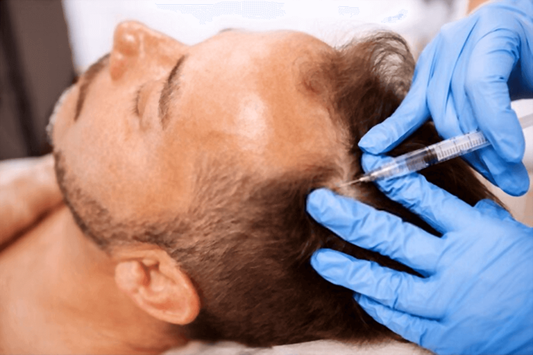 Mesoterapia-Capilar